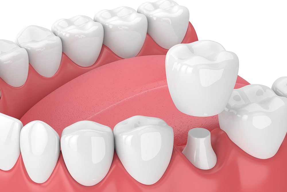 How Long Do Dental Crowns Last?